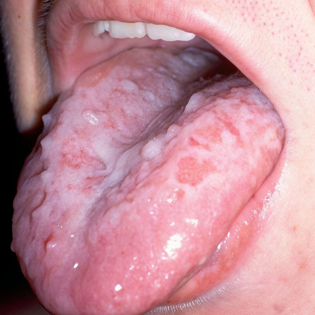 Liken Planus
